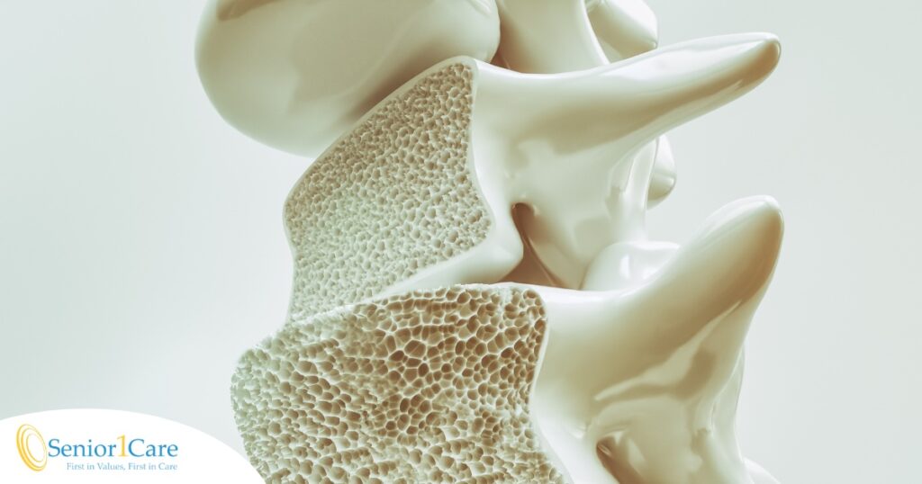 An image of a spine with the inside exposed represents osteoporosis.